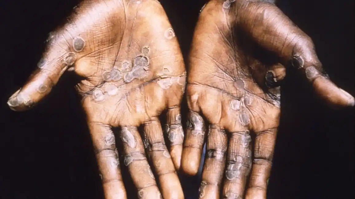 Viruela del mono: declaran la emergencia sanitaria internacional