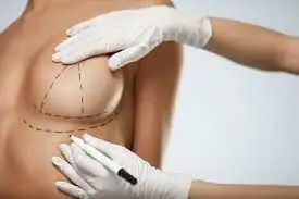 Aumento mamario sin implantes