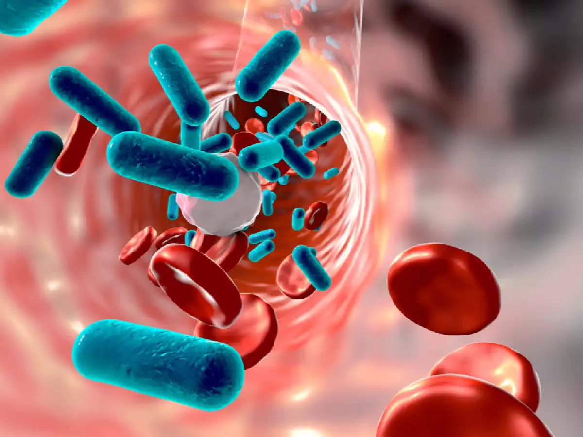 La sepsis, una infección en todo  el cuerpo que puede ser fatal