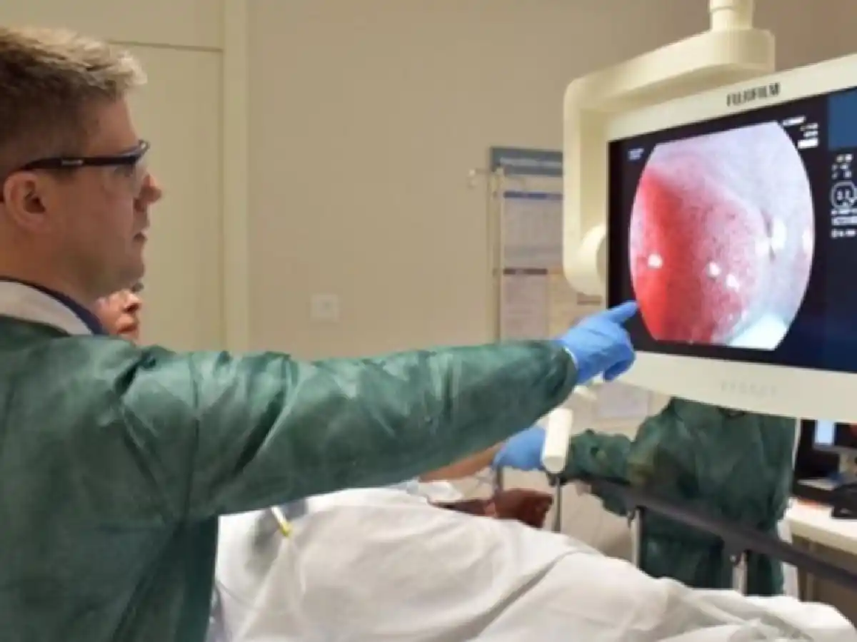 El cáncer de colon afecta cada vez más a los jóvenes, la  clave es hacerse la colonoscopía 