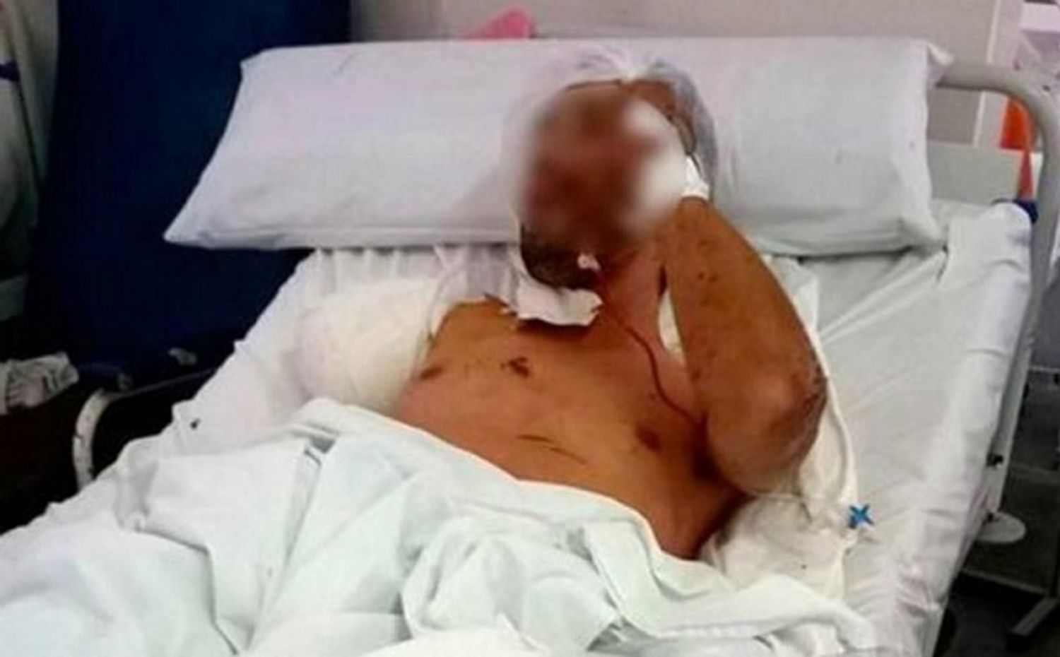 Le amputaron un brazo a un ladrón que fue atacado por un pitbull