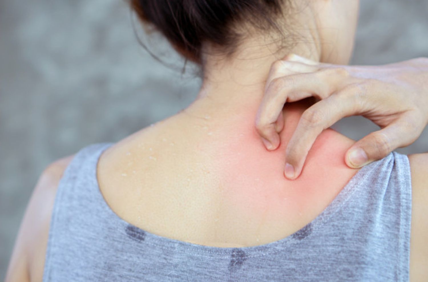 Aprueban droga para la Dermatitis atópica