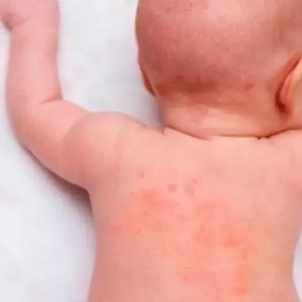 alergia a la proteína de la leche de vaca