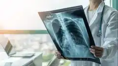  Cáncer de Pulmón, principal causa de muerte oncológica en Argentina