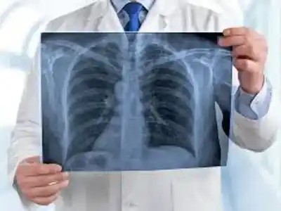 Día Mundial del Cáncer de Pulmón: advierten sobre el crecimiento sostenido de casos y la importancia del diagnóstico temprano