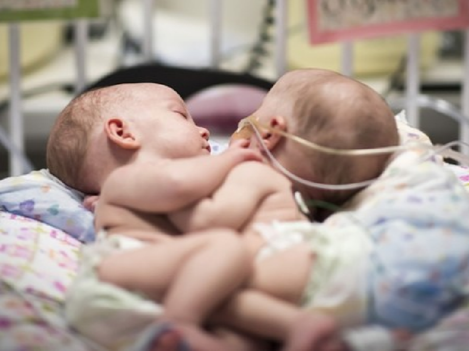 Separan con éxito a bebés siameses por primera vez en el país