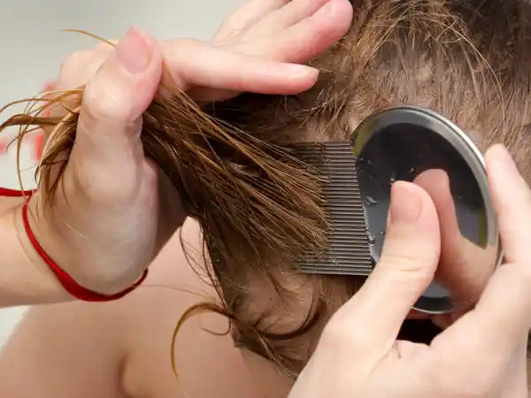 Piojos, pie de atleta y otitis: Los males de las colonias y vacaciones de verano