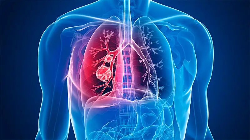 ANMAT aprobó un fármaco que elimina rastros de cáncer de pulmón en gran porcentaje