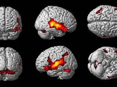 Científicos establecen relación entre la forma del cerebro y desarrollo de enfermedades mentales