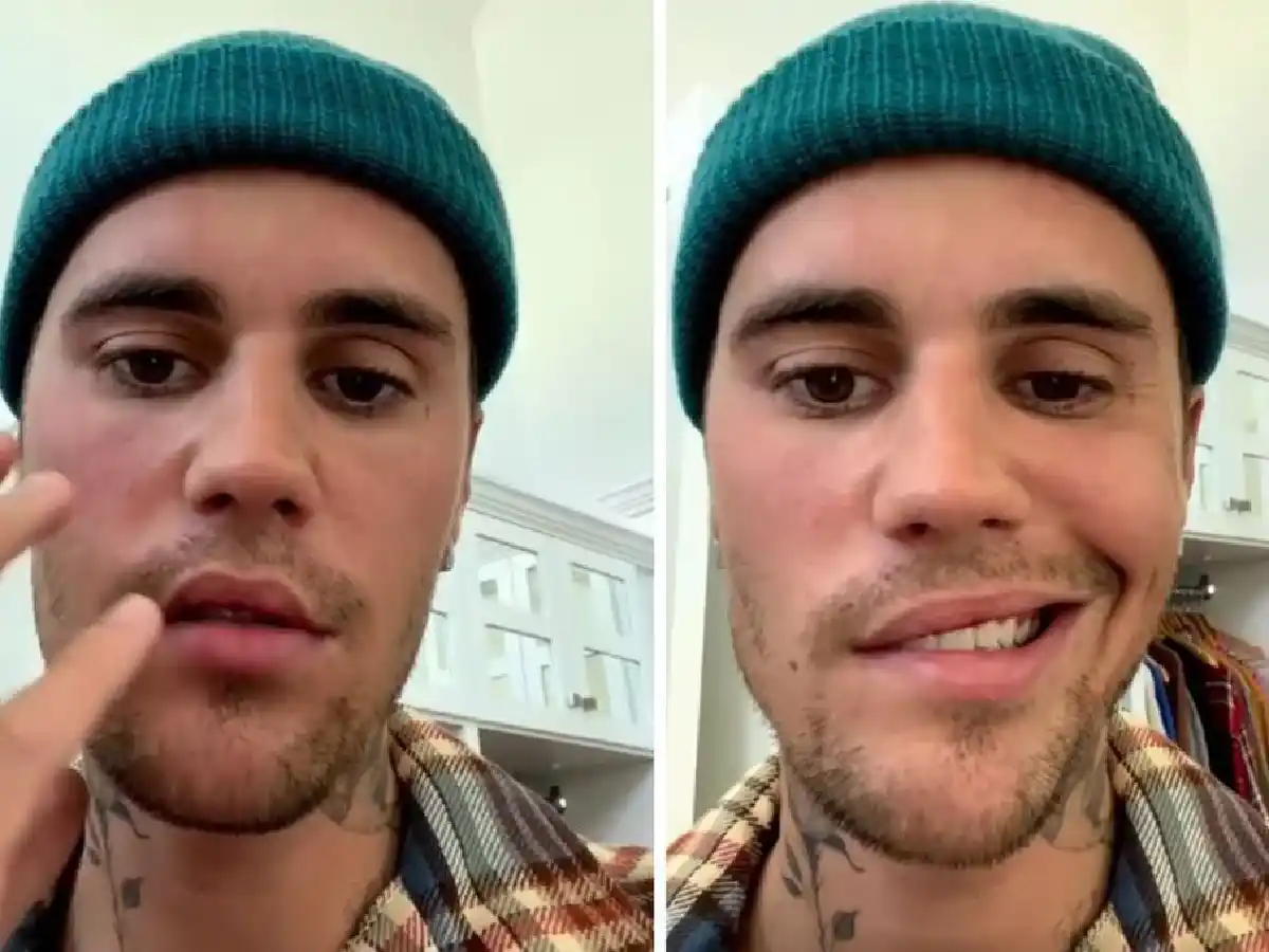 Qué es el síndrome de Ramsay Hunt, que obligó a Justin Bieber a cancelar shows en Argentina