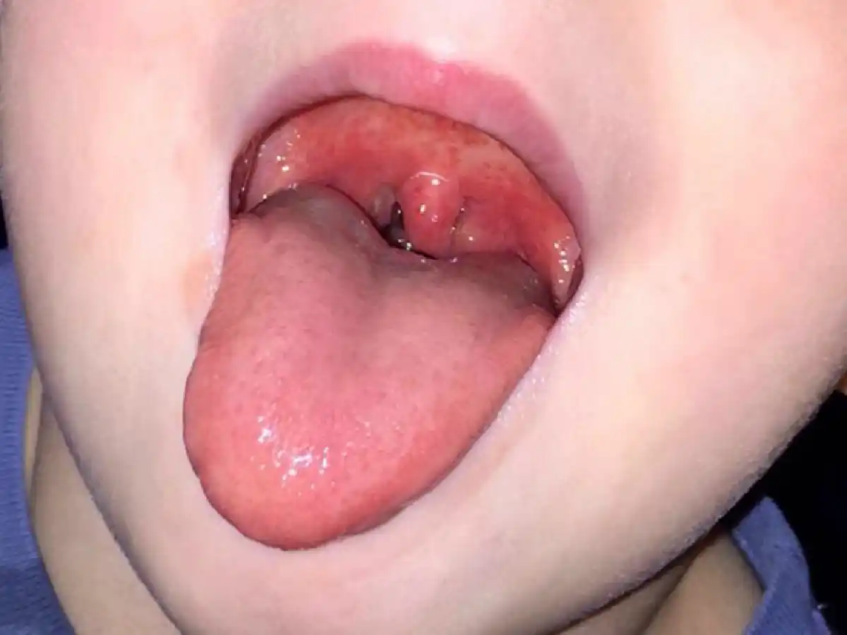 Bacteria streptococcus: la Sociedad Argentina de Pediatría explica qué hacer si aparecen los síntomas