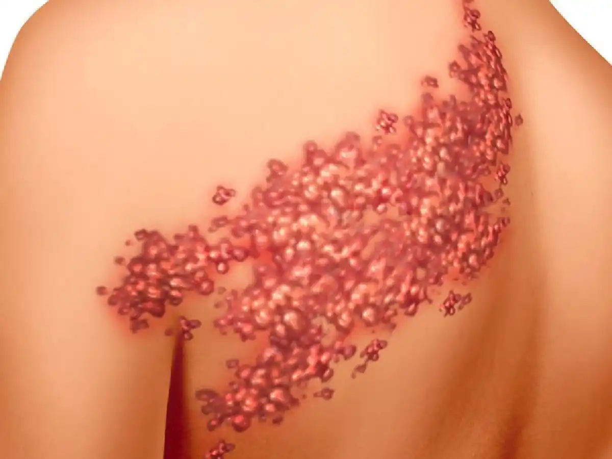 Culebrilla en la piel: cuáles son los síntomas y cómo es el tratamiento 