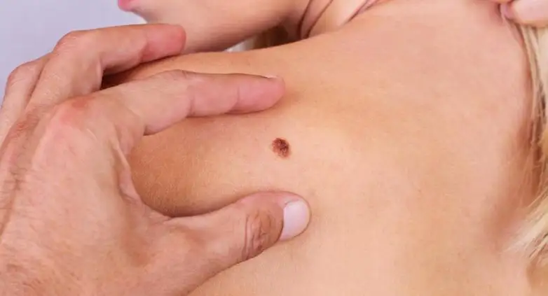 El melanoma es un tipo de cáncer detectable a simple vista.