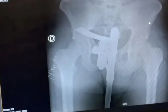 Sorpresa para el personal de salud: buscaban una fractura y encontraron una pistola