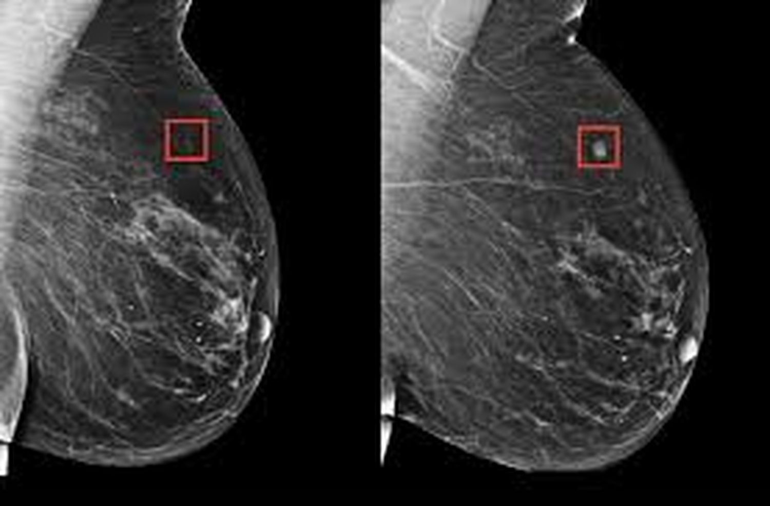IA puede identificar mujeres con RIESGO ELEVADO DE CÁNCER DE MAMA varios años antes del diagnóstico