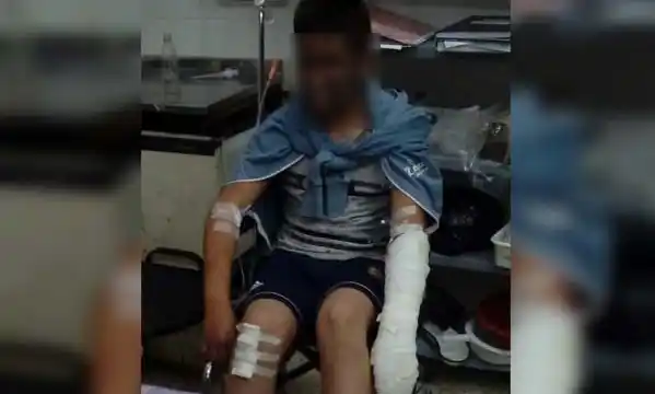 Un niño de 12 años se quemó la cara, el brazo y la pierna: fue trasladado