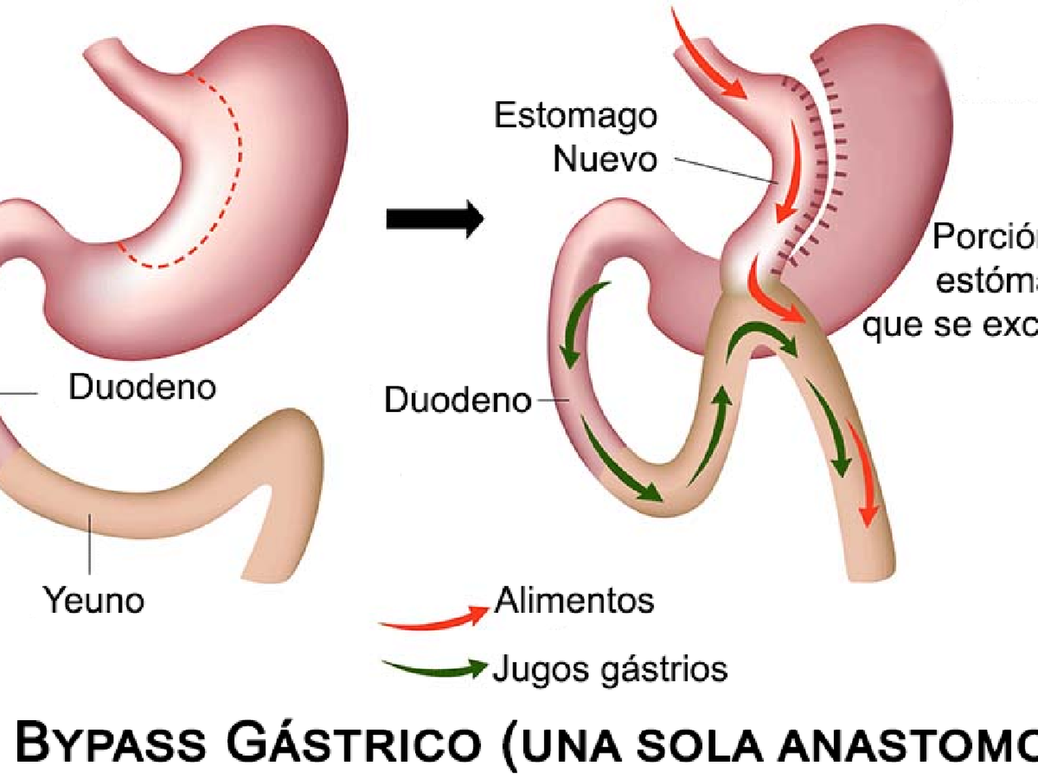 Cirugía de la obesidad: aplican en la ciudad una nueva técnica menos invasiva
