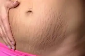 Estrías