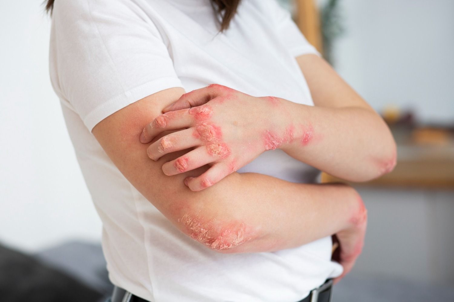Dermatitis atópica: ¿qué es y cómo hacemos para prevenirla?