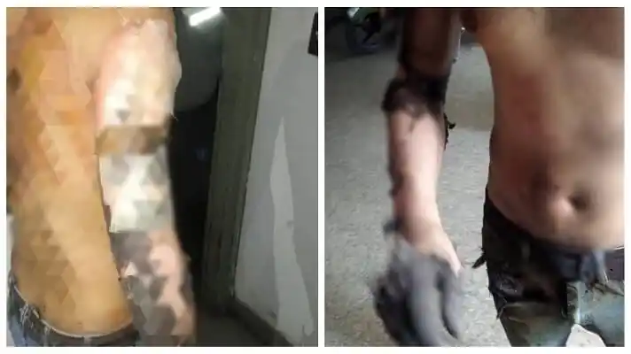 ¡TERRIBLE! Tres trabajadores del Metro de Caracas resultaron quemados en una explosión