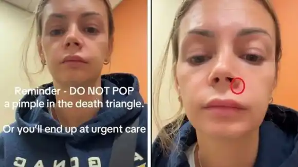 Se reventó un grano en el “triángulo de la muerte” y terminó en el hospital: el caso viral que alerta sobre los riesgos