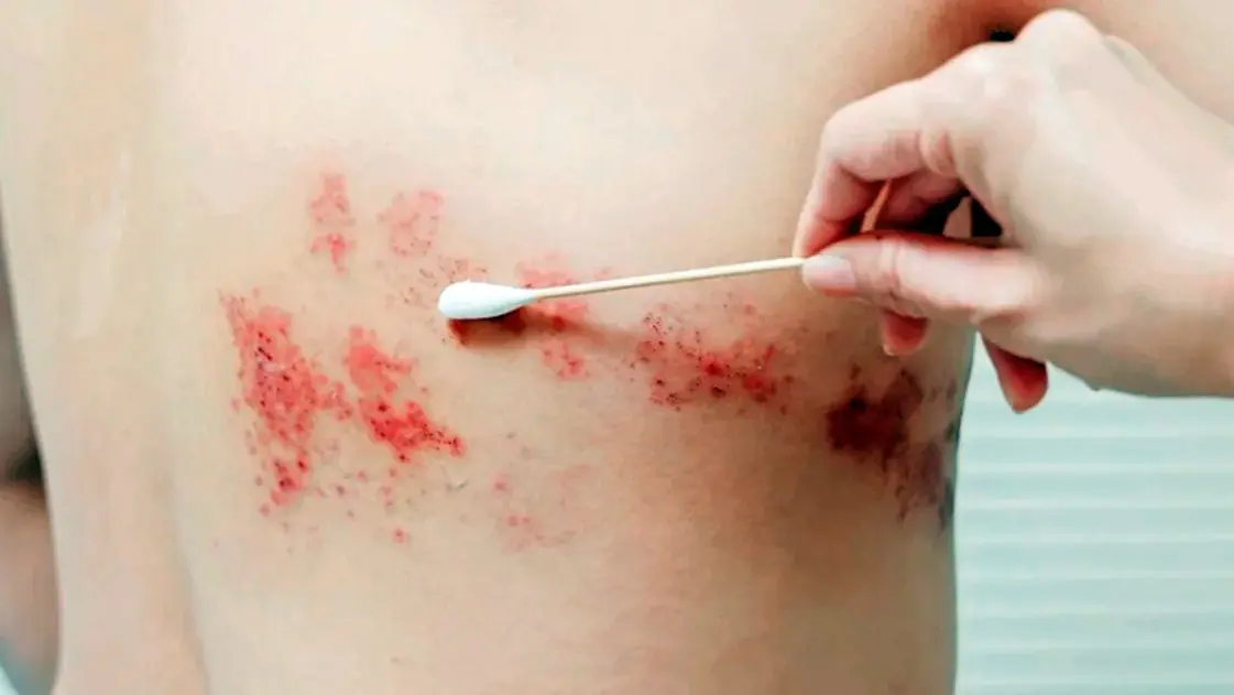 herpes zóster