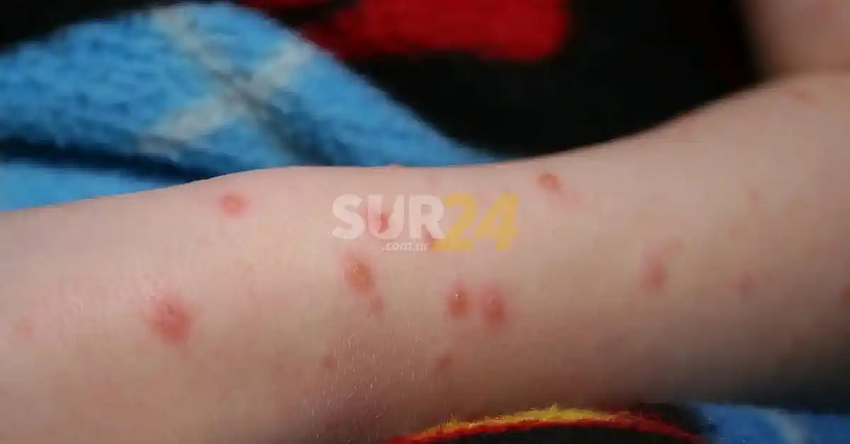 Detectaron el primer caso sospechoso de viruela del mono en Argentina