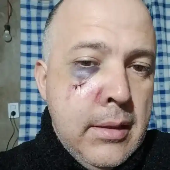 luis romero chofer agredido sufrió fractura de pómulo