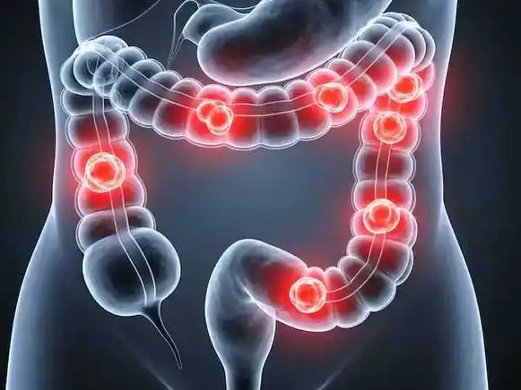 Una de cada seis personas operadas por cáncer
colorrectal en Argentina tiene menos de 50 años