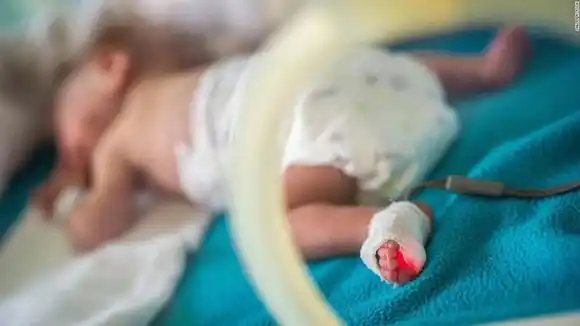 Los bebés prematuros pueden tener un mayor riesgo de muerte temprana cuando son adultos