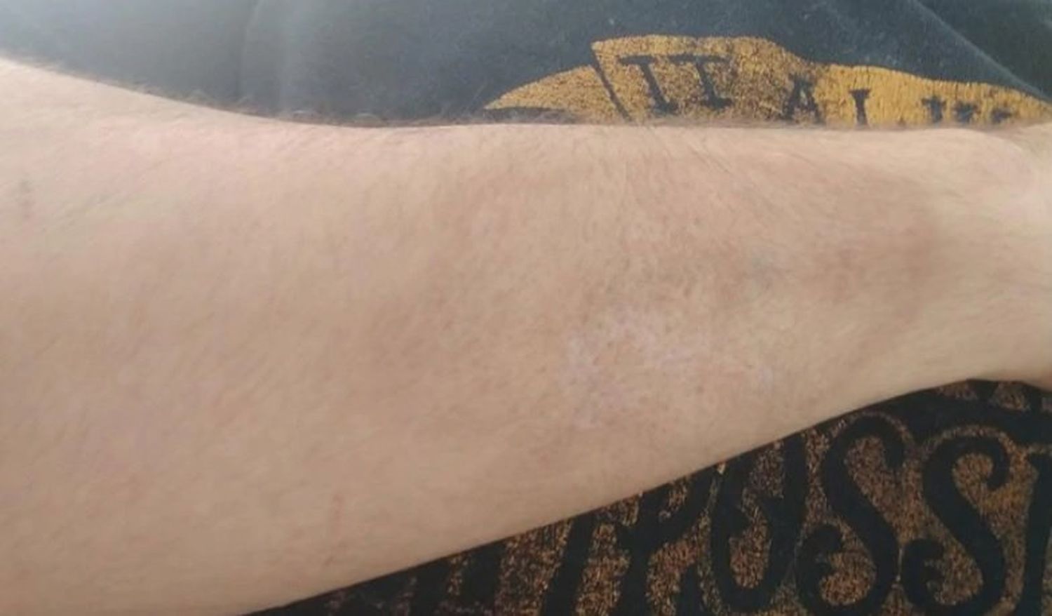 Así tiene el brazo en la actualidad  