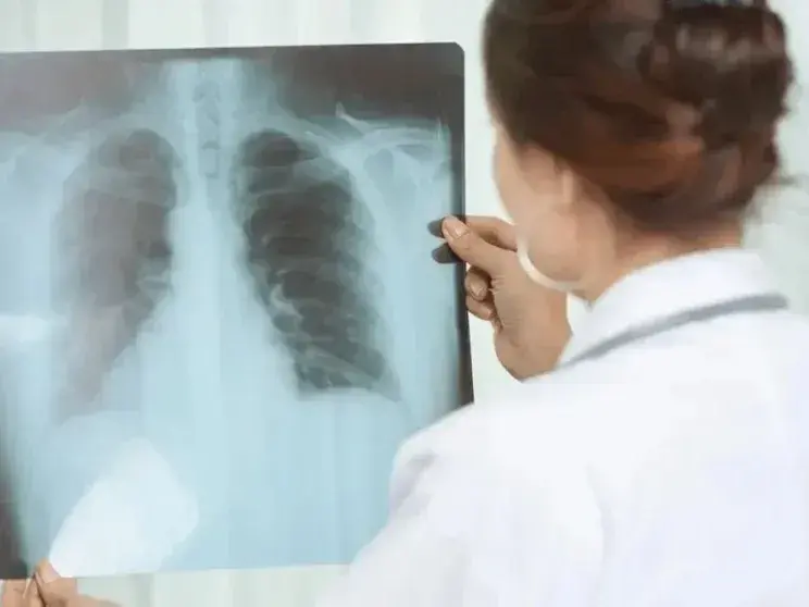 Alerta sanitaria: Los casos de tuberculosis aumentaron casi un 39% en lo que va de 2026
