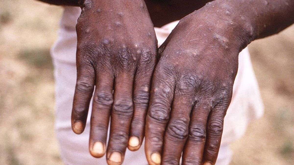 ¿OTRA PLAGA MÁS? Al menos 20 casos confirmados de viruela del mono en Europa