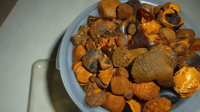 calculos billiares detenido casilda - 3