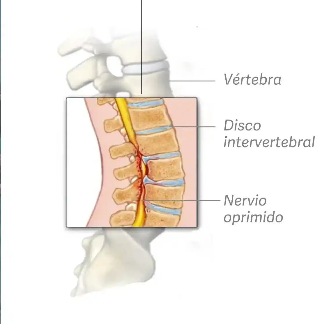 estenosis lumbar