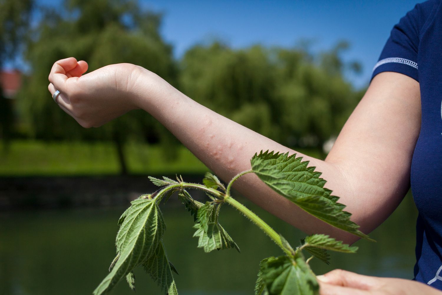 La palabra “urticaria” proviene del nombre científico de la ortiga: Urtica urens.