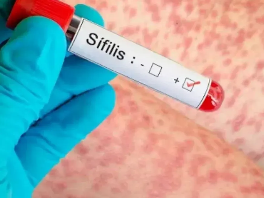 Alerta por sífilis en Argentina: aumento de reinfecciones en hombres. Gentileza