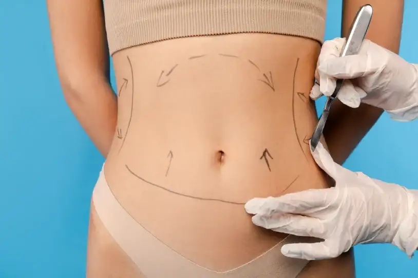 Aspectos a tener en cuenta a la hora de pensar en una lipoescultura