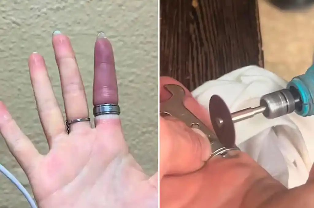 Una usuaria compartió cómo rescataban a su dedo de un anillo (@jjuliharley)