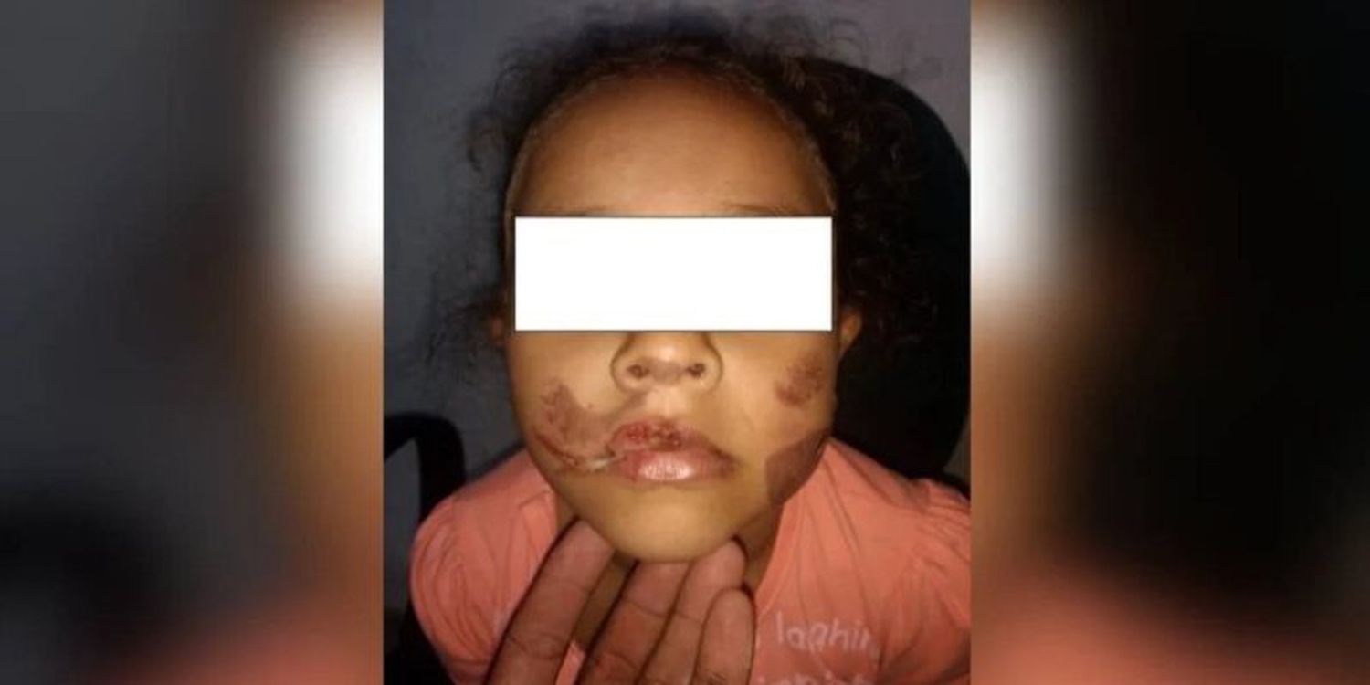 LE QUEMÓ la cara a su hija de 7 años por comer a escondidas