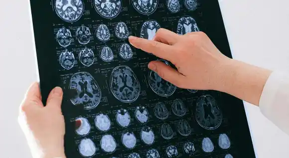 Identifican nueva vía  que podría cambiar  rumbo del tratamiento contra el Alzheimer