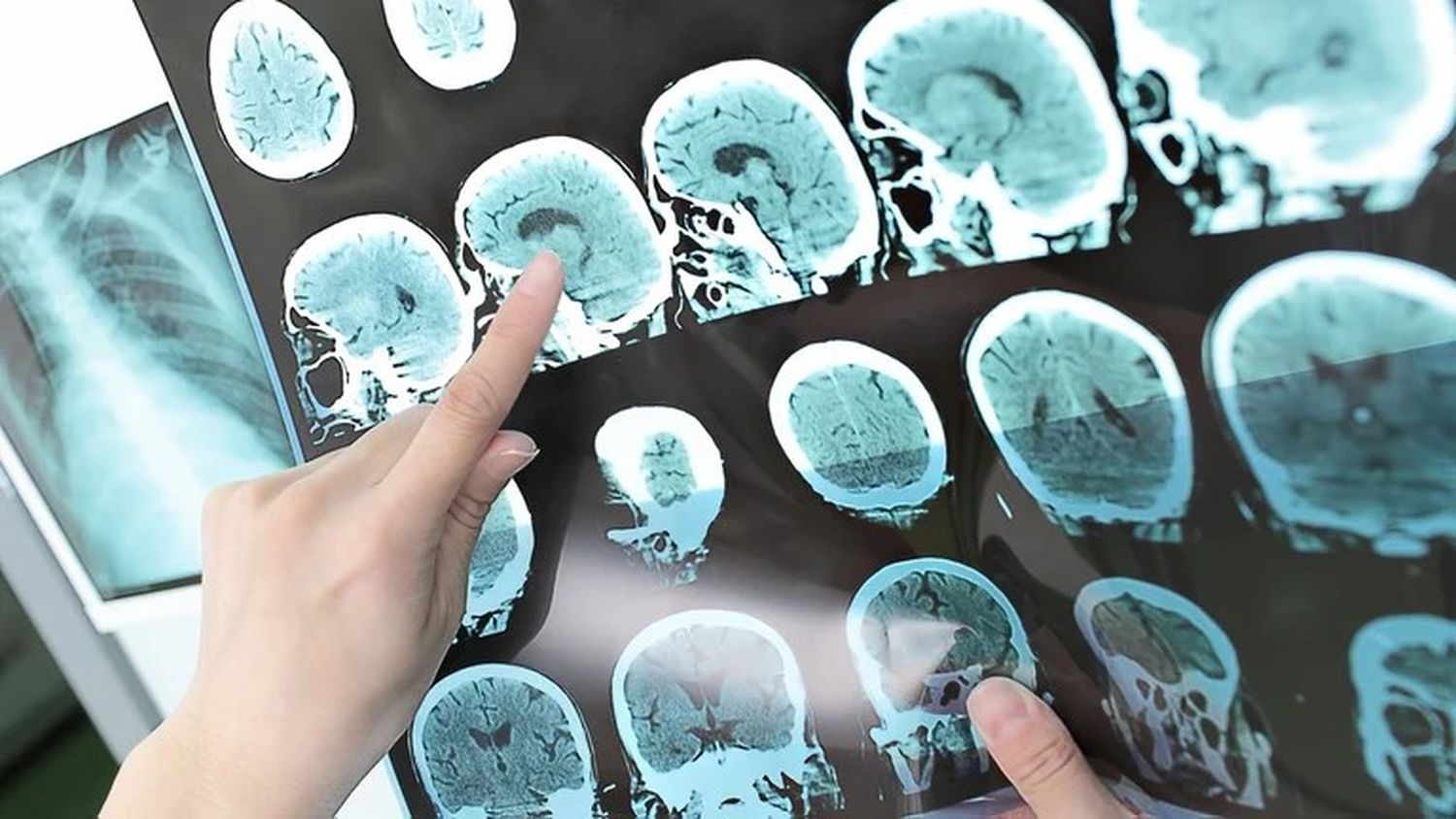 El virus que provoca la mononucleosis podría ser la causa principal de la esclerosis múltiple
