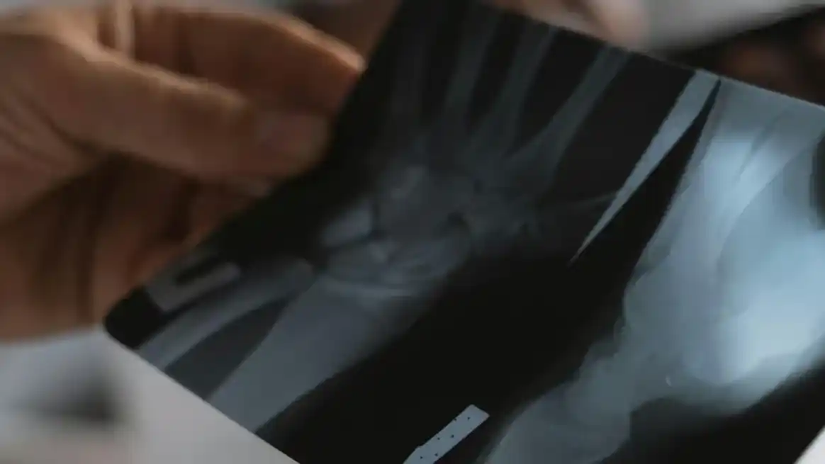 Podría aplicarse tanto en fracturas simples como en aquellas más complicadas.