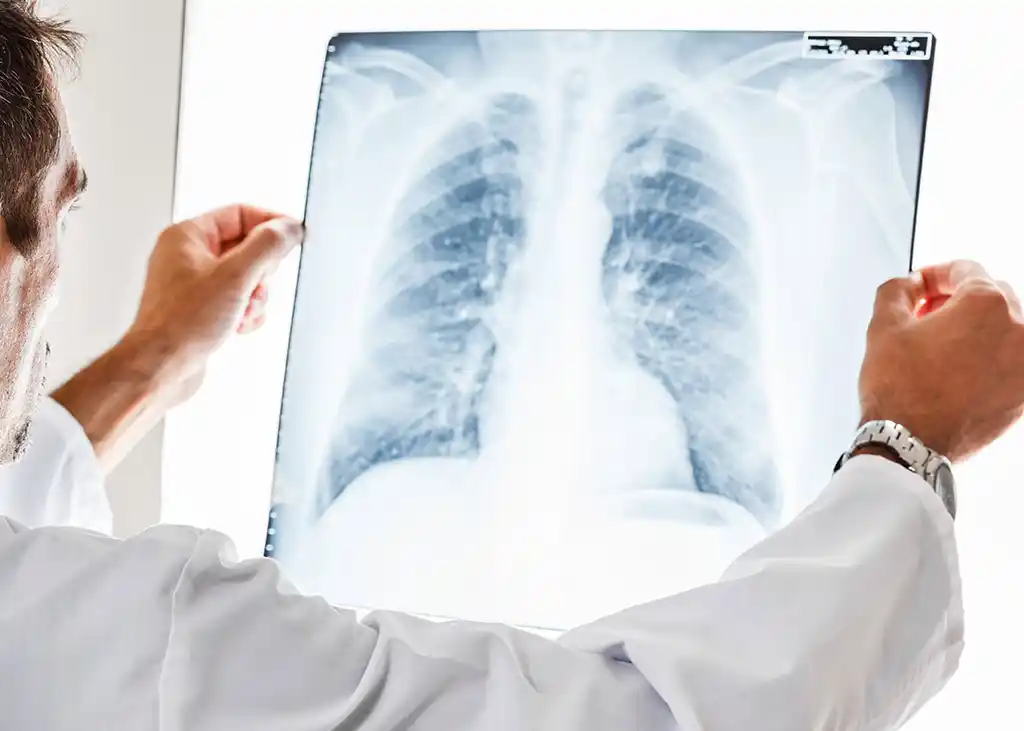 Los nódulos pulmonares se relacionan con el cáncer