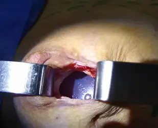 Botched