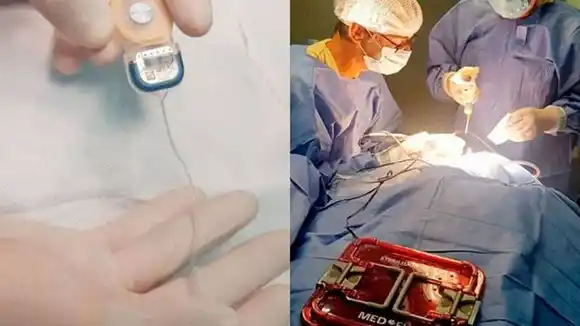 Un nuevo modelo de implante le permitirá volver a escuchar a dos personas en San Luis