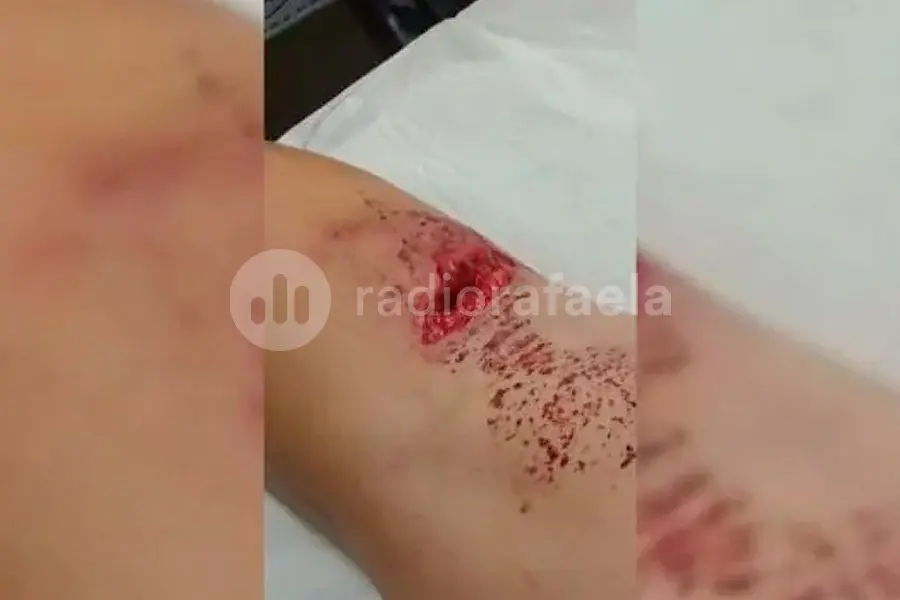 Terrible: un perro atacó a un nene de 7 años en Santa Fe: el dueño "no hizo nada"