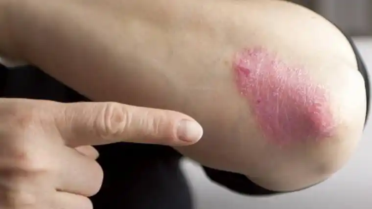 Comienza la campaña gratuita de detección de psoriasis