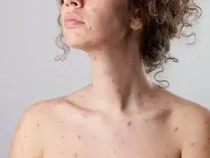 varicela