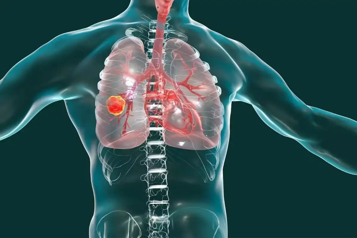 Qué es un adenocarcinoma pulmonar, el tumor maligno que le diagnosticaron a León XIV